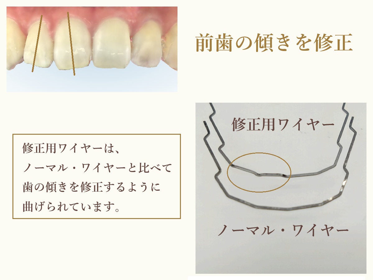 ハーフリンガル歯列矯正 - 東京で矯正歯科は新宿のTBDC